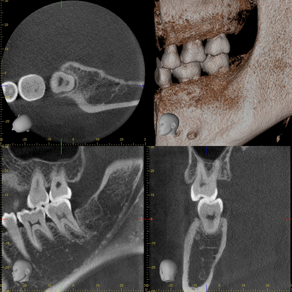 ひらい歯科 CT撮影表示画面